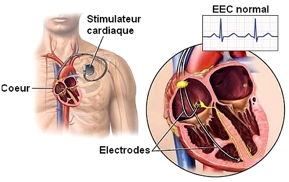 Stimulateur cardiaque